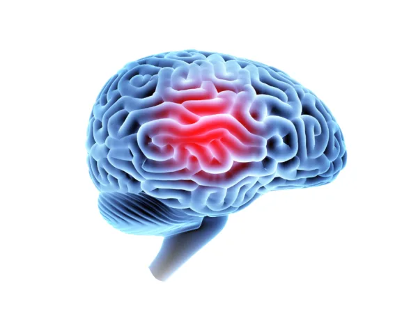 headache-area-on-brain-x-ray-side-view-isolated-on-white-background-3d-illustration-stockpack-gettyimages Headache area on brain X-ray, side view isolated on white background. 3D illustration.